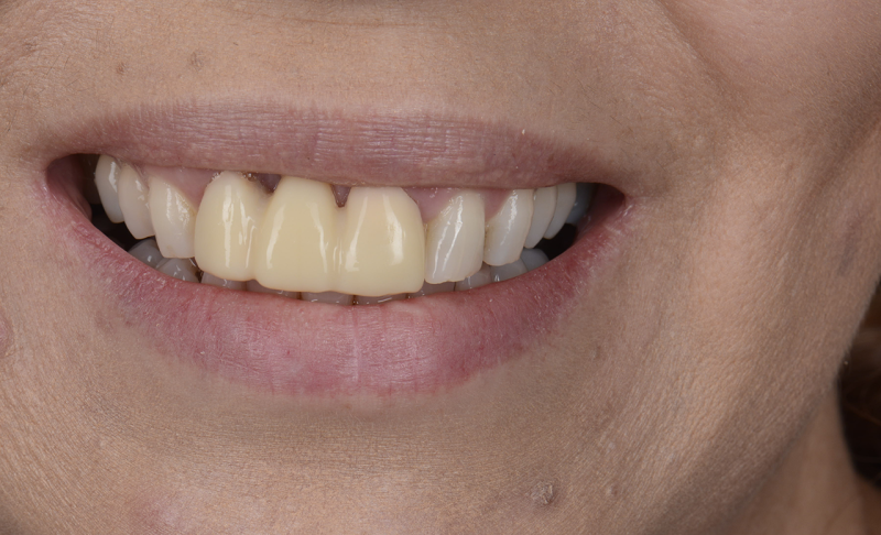 Before Teeth Bridge 