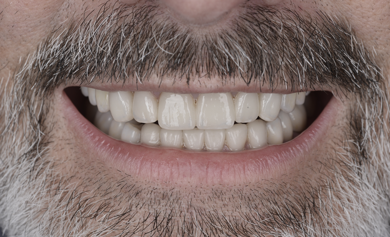 After Full Mouth Reconstruction – Braces and Crowns 