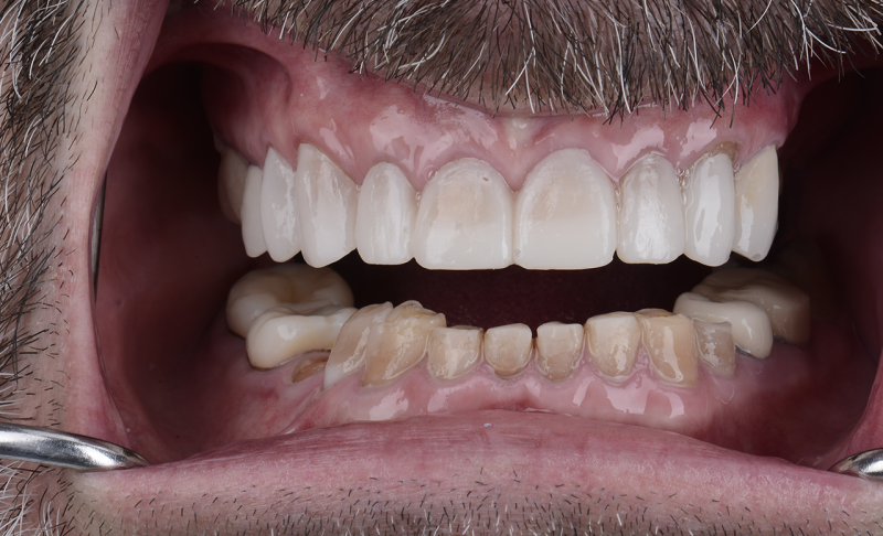 Before Full Mouth Reconstruction – Braces and Crowns 