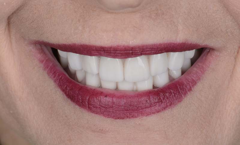 After Full Mouth Rehabilitation –  All Crowns