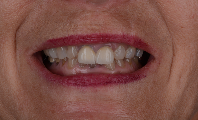 Before Full Mouth Rehabilitation –  All Crowns