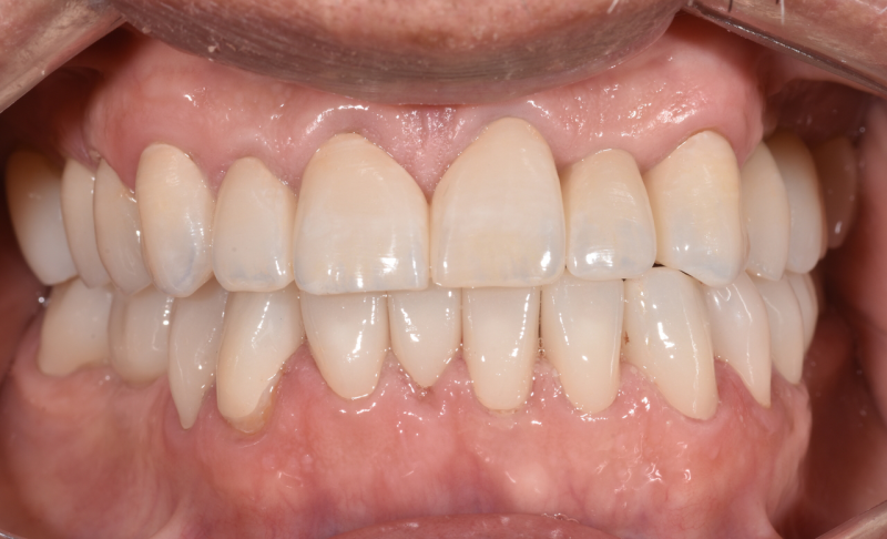 After Full Mouth Reconstructions – Crowns, Root Canal, and Single Implants