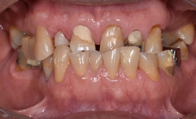 Before Full Mouth Reconstructions – Crowns, Root Canal, and Single Implants