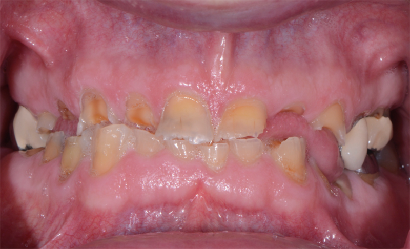 Before Full Mouth Rehabilitation