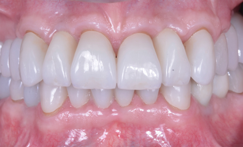 After Full Mouth Rehabilitation