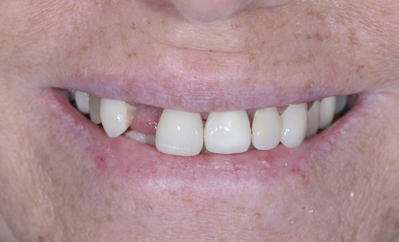 Before Smile Makeover – Single Implants and Veneers