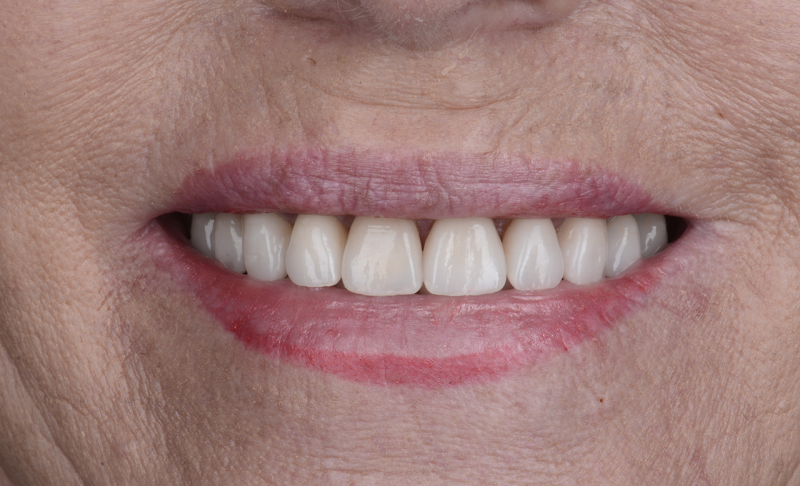 After Smile Makeover – Single Implants and Veneers