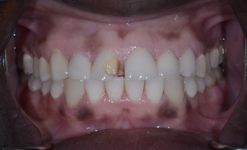 Before Smile Makeover – Crowns