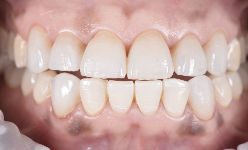After Smile Makeover – Crowns