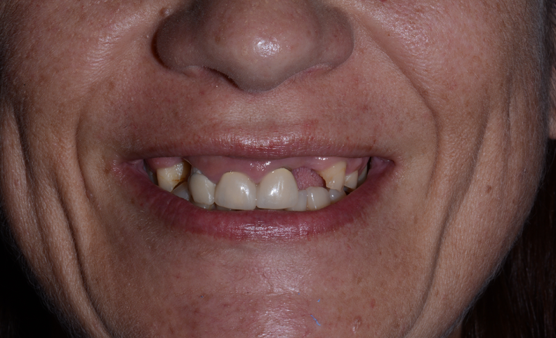 Before Smile Makeover – Crowns and Veneers 