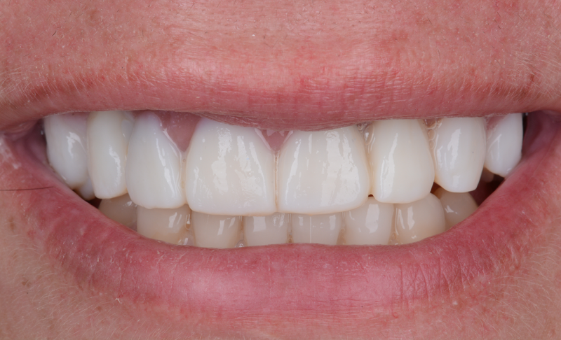 After Smile Makeover – Crowns and Veneers 