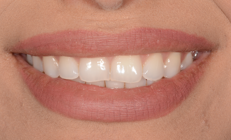 Before Teeth Whitening and Two Veneers 