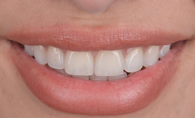 After Teeth Whitening and Two Veneers 