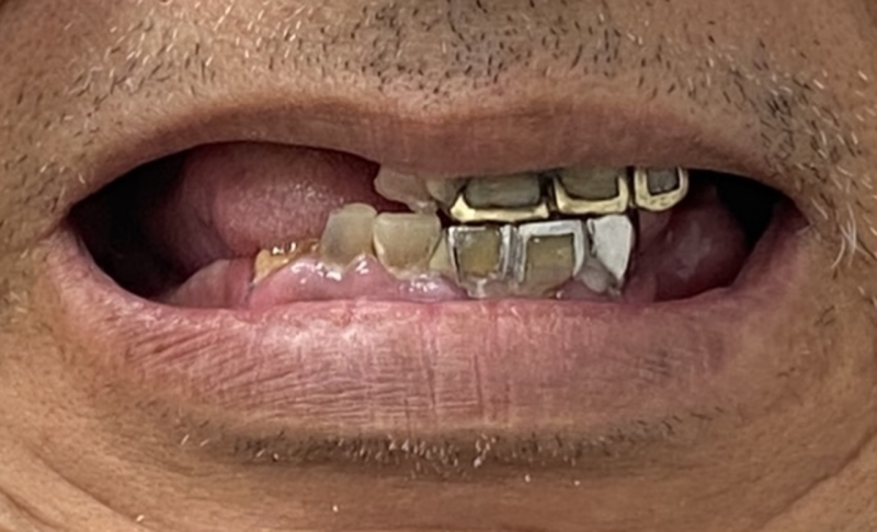 Before Upper and Lower Full Mouth Implants 