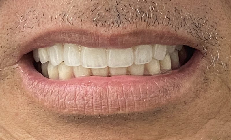 After Upper and Lower Full Mouth Implants 