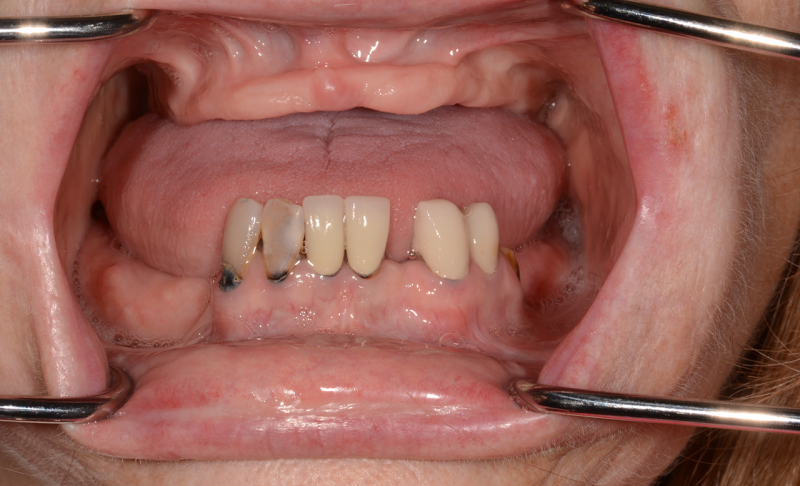Before Upper Denture and Lower All-on-4 